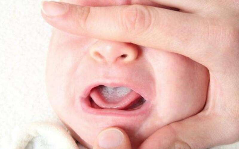 Trẻ bị trắng lưỡi là chứng bệnh thường gặp ở trẻ sơ sinh