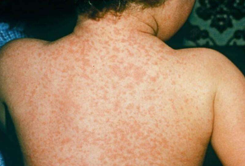 phan-biet-soi-va-sot-bang-02 Sốt phát ban không quá nguy hiểm
